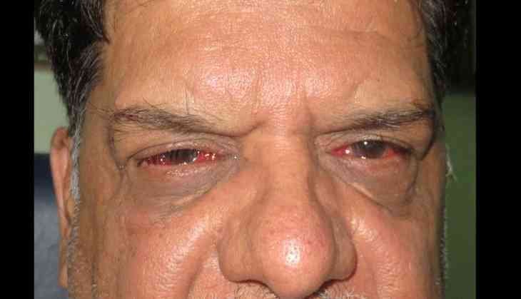 Viral Eye Flu
